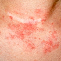 Bőrbetegségek ekcéma pikkelysömör kezelése, A pikkelysömör tünetei